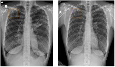 Pulmonary infection by Mycobacterium riyadhense: first case report in United Arab Emirates